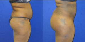 Before and After Brazilian Butt Lift