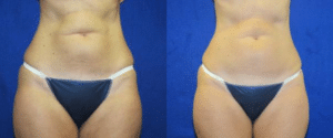 before-and-after-liposonix