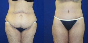 before-and-after-lower-body-lift