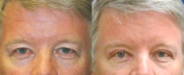 before-and-after-eyelid-surgery