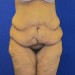 PATIENT 227 Before