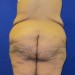 PATIENT 227 Before - 2