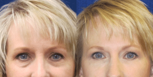 Injectable Fillers Before and After Photos