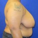 PATIENT 235 Before - 2