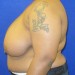 PATIENT 235 Before - 3