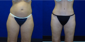 Before and After Liposuction Surgery