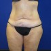 PATIENT 240 Before - 2