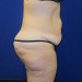 PATIENT 240 Before - 3