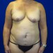 PATIENT 243 Before