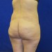 PATIENT 242 Before - 2