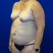 PATIENT 243 Before - 2