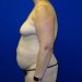 PATIENT 243 Before - 3