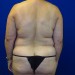 PATIENT 243 Before - 4