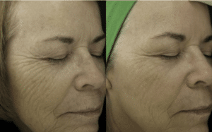 Before and After Fraxel by Dr. Wilson