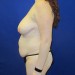 PATIENT 248 Before - 3