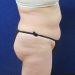PATIENT 251 B Before - 2