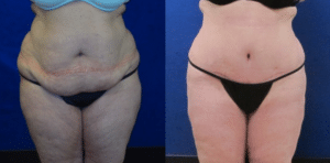 Wilson Liposuction Patient