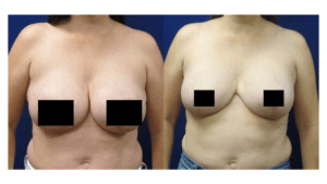 Dr. Wilson - Breast Revision
