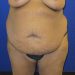 PATIENT 255 Before