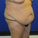 PATIENT 255 Before - 2