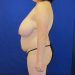 PATIENT 259 Before - 3