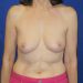 PATIENT 260 B Before