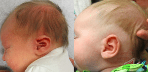 EarWell™ Infant Ear Correction by Dr. Wilson