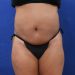 PATIENT 290 Before - 3