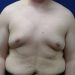 PATIENT 292 Before