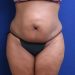 PATIENT 297 Before - 3