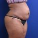 PATIENT 297 Before - 2