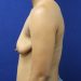 PATIENT 298 Before - 3