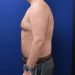 PATIENT 320 Before - 2