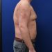PATIENT 320 Before - 3