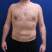 PATIENT 320 After