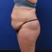 PATIENT 328 Before - 3
