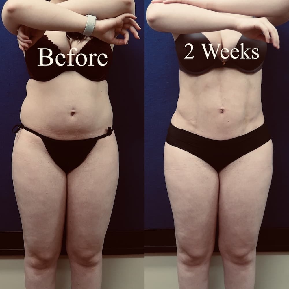 Before and after image showing the results of a liposuction patients 2 weeks after surgery