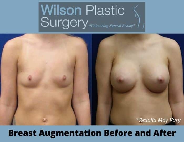 Before and after image showing the results of a breast augmentation performed in Huntsville, AL.