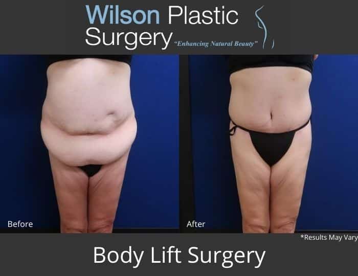 Before and after image showing the results of a body lift performed.