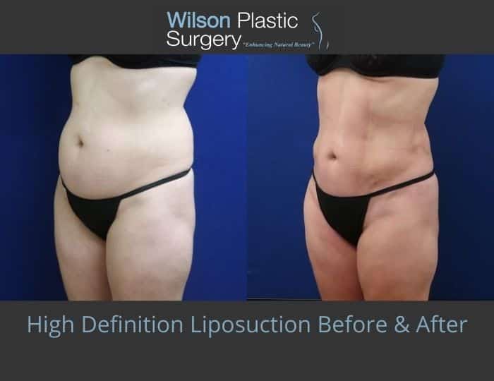 Before and after image showing the results of a high definition liposuction patient in Huntsville, AL.