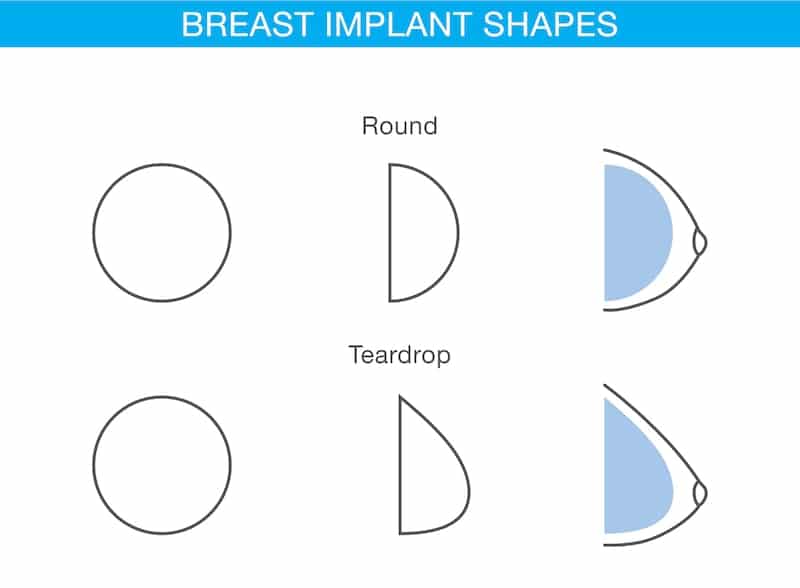 Illustration demonstrating the difference between round and teardrop-shaped implants.