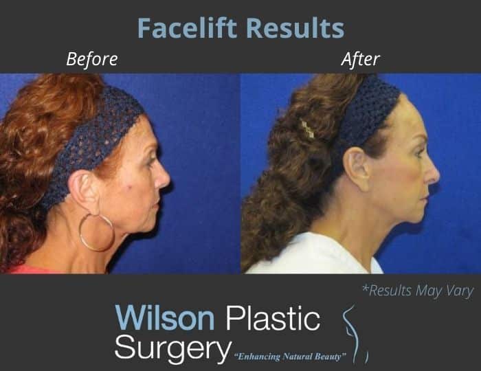 Before and after image showing the results of a facelift performed in Huntsville, AL.