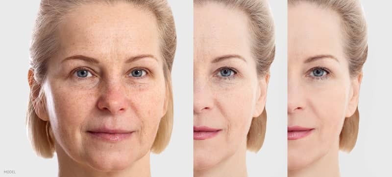 Woman with different extent of facial aging, side-by-side images.