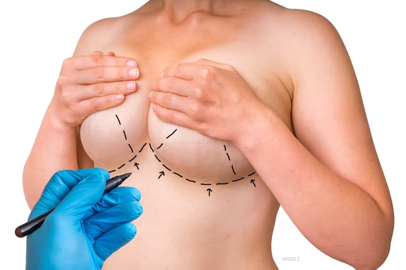 Woman in a breast surgery consultation with her surgeon making pen markings on her breasts.