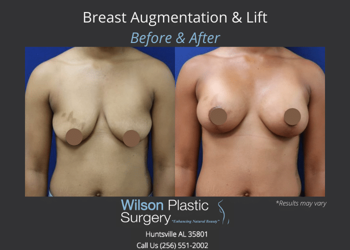 Before and after image showing the results of a breast augmentation and lift performed in Huntsville, AL.