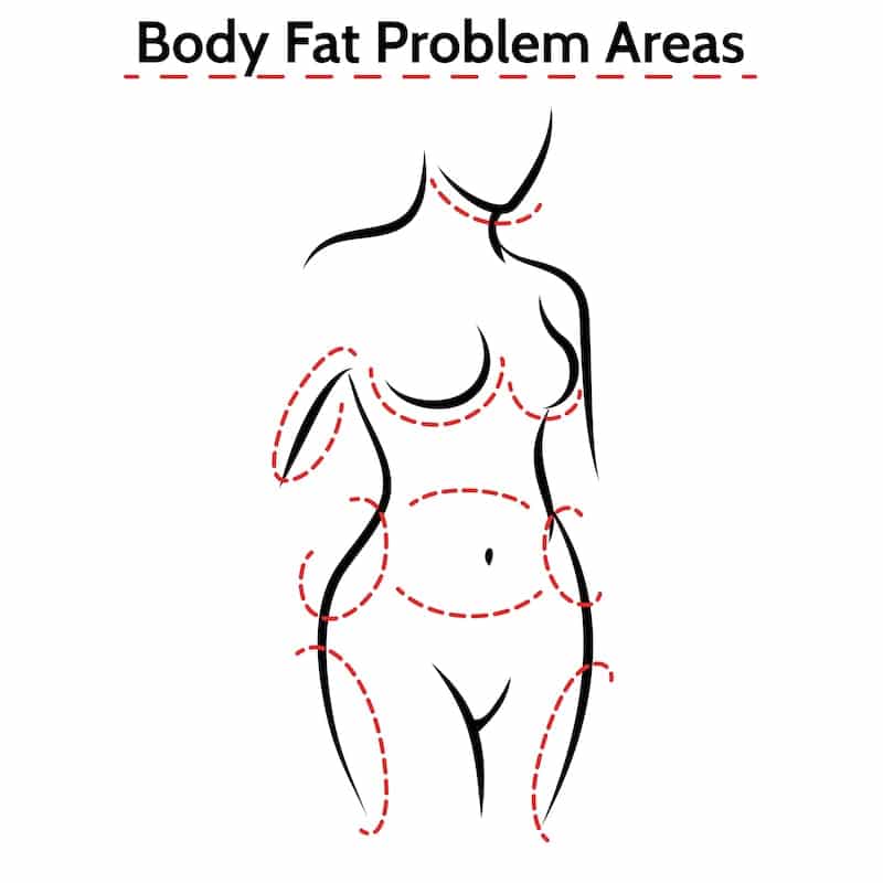 Illustration of liposuction treatment areas. 