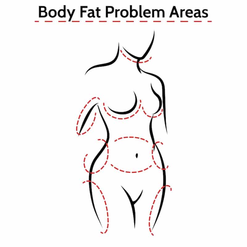 Illustration of liposuction treatment areas.