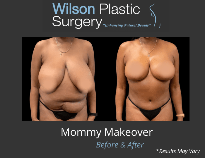 Before and after image showing the results of a Mommy Makeover performed in Huntsville, AL.