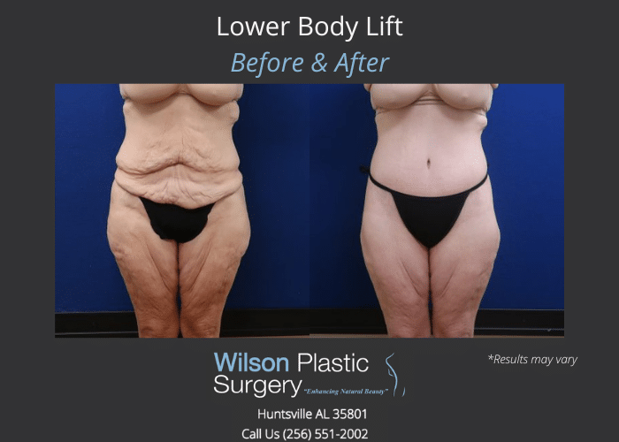 Before and after image showing the results of a body lift performed in Huntsville, AL.
