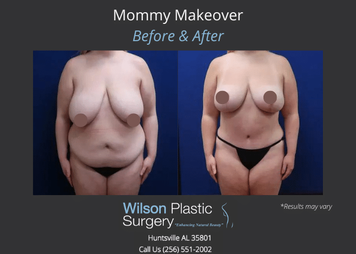Before and after image showing a Mommy Makeover. 